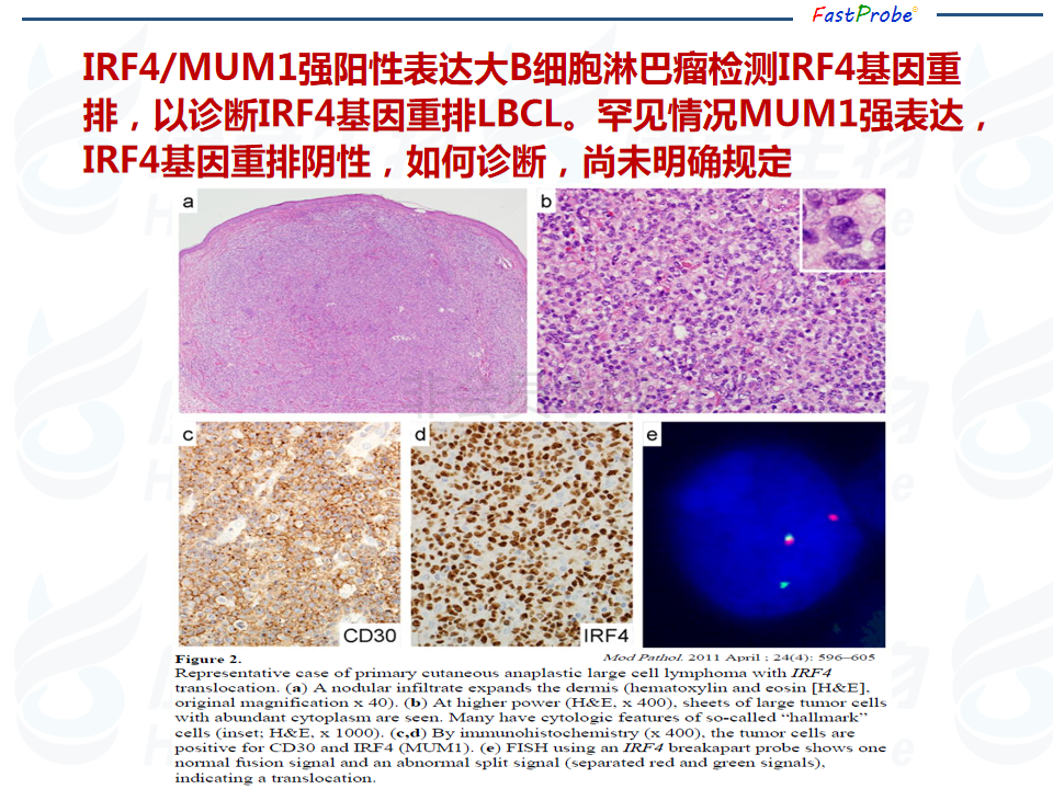 淋巴瘤FISH检测10件事 中到大大细胞篇_14.png